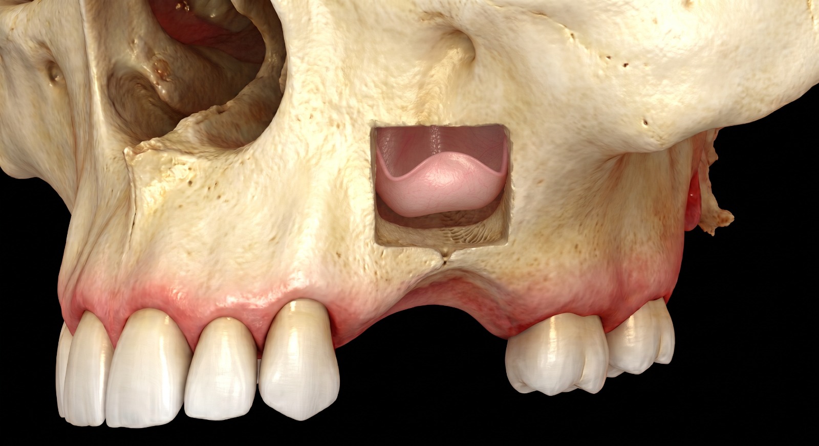 Step 1: the atrophic maxillary ridge with the sinus membrane exposed before grafting